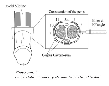 Penile Injection